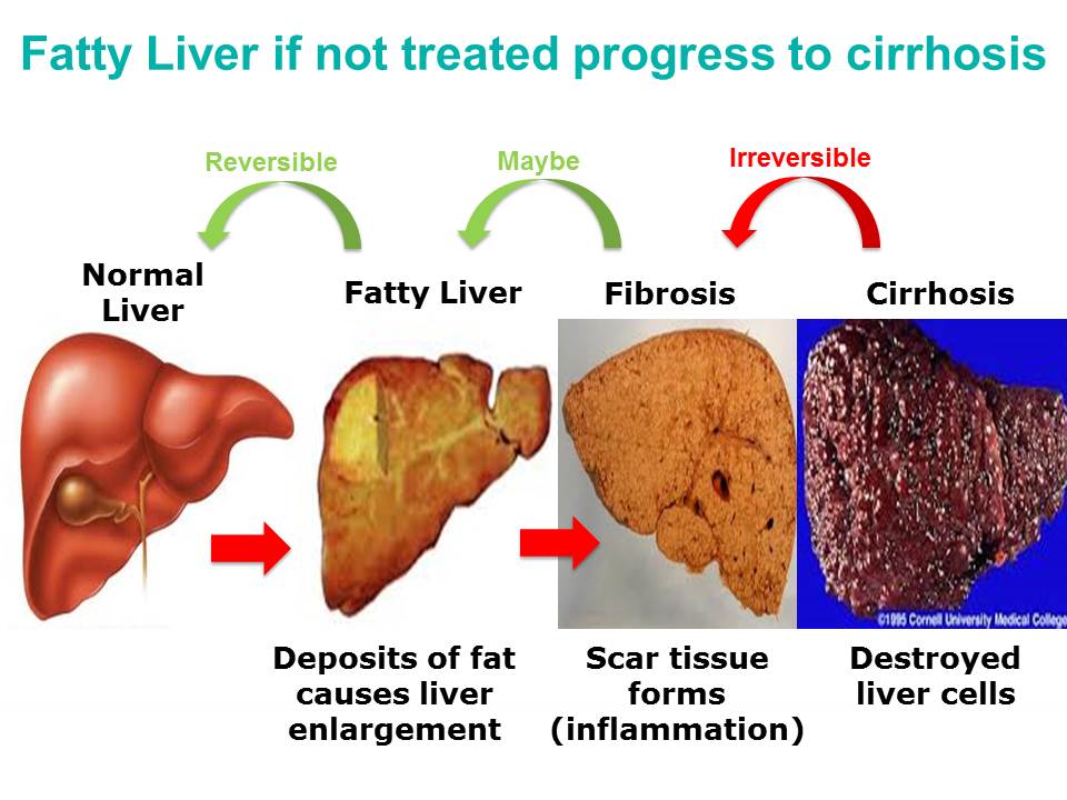 what does a fatty liver mean
